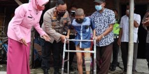Harus Diamputasi Akibat Kanker Tulang, Kiki Kini Bisa Jalan Lagi Berkat Kaki Palsu Pemberian Kapolres Demak