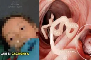 Tragedi Balita Sukabumi: Tertular Cacing Parasit Parah, Gubernur Minta Audit RS