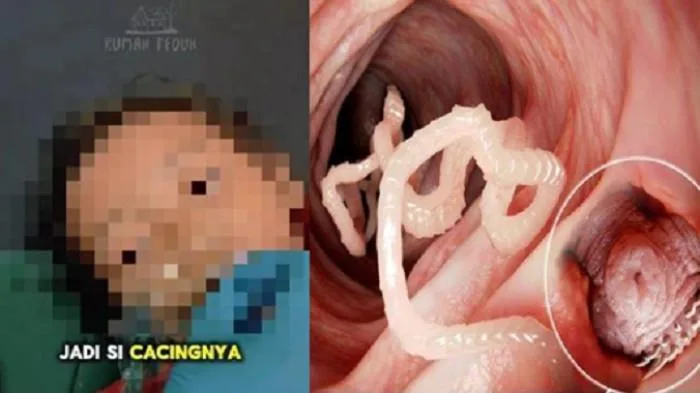 Tragedi Balita Sukabumi: Tertular Cacing Parasit Parah